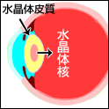 水晶体嚢外摘出術