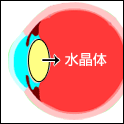 水晶体嚢内摘出術